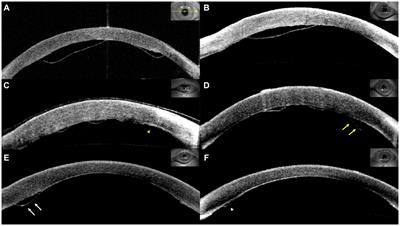 Risk factors for early graft detachment requiring rebubbling in Descemet membrane endothelial keratoplasty with imported pre-cut donor tissues